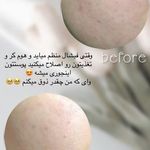مرکز پاکسازی و پلاژن تراپی سیلکی فیشال
