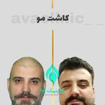 کلینیک تخصصی پوست و کاشت مو آوا