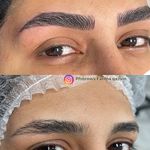 بهترین میکروبلیدینگ و فیبروز خرازی