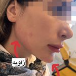 آفر ۹۰ درصدی ژل و بوتاکس و پی آر پی‌ و نخ
