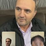 کلینیک کاشت مو زمرد