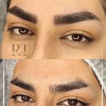 مرکز میکروبلیدینگ شیدینگ ریموو اسکالپ