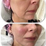 تزریق ژل و بوتاکس عبداله کوخی