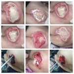 کارشناس زخم و متخصص کیوم تراپی بهرامی فر