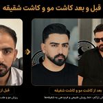 کاشت مو شیراز و کاشت شقیقه صادق نیا