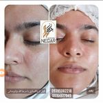 فیشیال و پاکسازی نگار