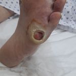 پانسمان تخصصی زخم و استومی