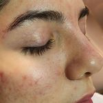 فیشال درمانی و پاکسازی پوست میرجلیلی