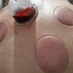 حجامت درمانی ، زالو درمانی و ماساژ درمانی