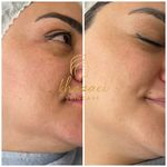 فیشال و پاکسازی پوست درنواب