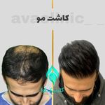 کلینیک تخصصی پوست و کاشت مو آوا
