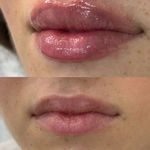 کلینیک هانیل | فیلر بوتاکس آنی‌لیفت شرق