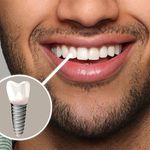 مرکز ایمپلنت دکتر نصیری متخصص فک و صورت