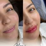 میکروبلیدینگ و شیدینگ مینا حسینی