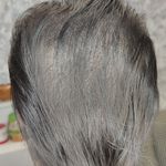 میکرو، شیدینگ لب ریموو تتو میکرواسکالپ ندا