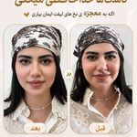 ژل و بوتاکس مونالیزا