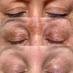 فیشال و پاکسازی پوست درنواب