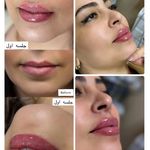 مرکز لیزر و فیلر وجوانسازی وزیبایی شاینا