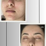 خدمات تخصصی فیشال و پاکسازی پوست صبا