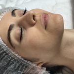 فیشال و پاکسازی صورت لوئیز