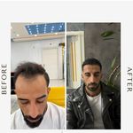 کاشت مو و ریش و ابرو مزوتراپیprp جناب