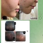 خدمات درمان جوش و لک ناهیدی