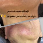 خدمات الکترولیز موهای زائد شاینا