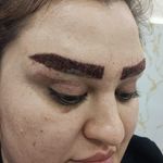 کاشت مو سر ابرو اردبیل و پارس آباد مرادی