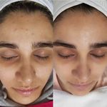 خدمات تخصصی پاکسازی پوست رویال اسکین