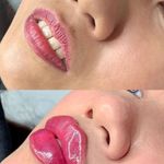 تزریق فیلر و بوتاکس توسط پزشک مجرب