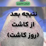 کاشت مو و ابرو (مرجان عاشوری)