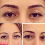 میکروپیگمنتیشن استار