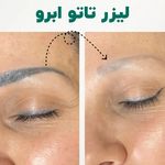 پاک کردن تتو بدن شادی