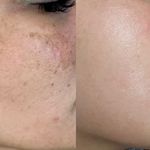 لیزر مو زائد و ژل و بوتاکس وجوانسازی