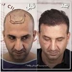 کاشت مو و ابرو در کلینیک شعبه اهر و سهند
