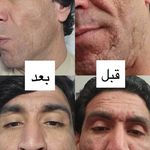 فشیال و پاکسازی پوست یعقوبی