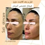 فیشال و پاکسازی تخصصی ساتی
