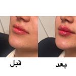 آفر ۹۰ درصدی ژل و بوتاکس و پی آر پی‌ و نخ