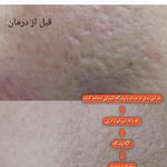 فیشال و درمان لک و اسکارو جوش