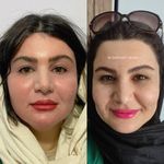 لیزر co2ترکیبی ضدلک وجوانساز کلینیک رایدو