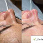 خدمات تخصصی فشیال و پاکسازی صورت سحر