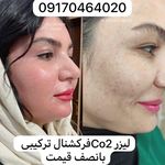 لیزر co2ترکیبی ضدلک وجوانساز کلینیک رایدو
