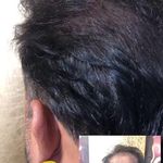 میکروبلیدینگ ابرو و میکرواسکالپ سر آقایان