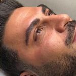 میکروبلیدینگ ابرو و میکرواسکالپ سر آقایان