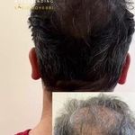 میکروبلیدینگ ابرو و میکرواسکالپ سر آقایان