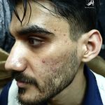 فیشال درمانی و پاکسازی پوست میرجلیلی