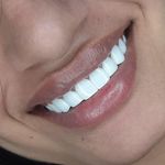 کامپوزیت زیبایی دندان