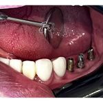 کلینیک دندانپزشکی،ایمپلنت دکترالهه صادقی