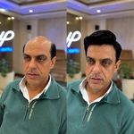 پروتز مو هیمن
