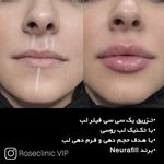 کلینیک تخصصی زیبایی رز - فیلر بوتاکس